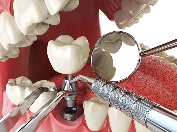 Best Emergency Root Canal Therapy in Bay Springs, MS